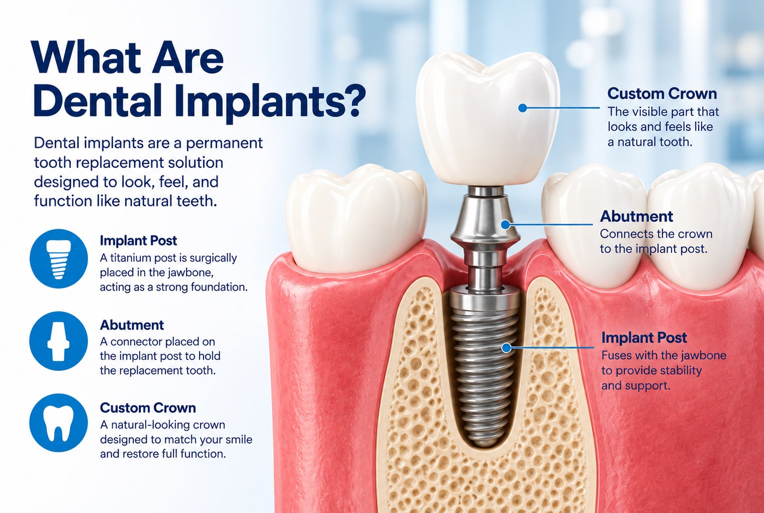 Dental implant diagram showing the implant post, abutment, and custom crown used to replace a missing tooth.