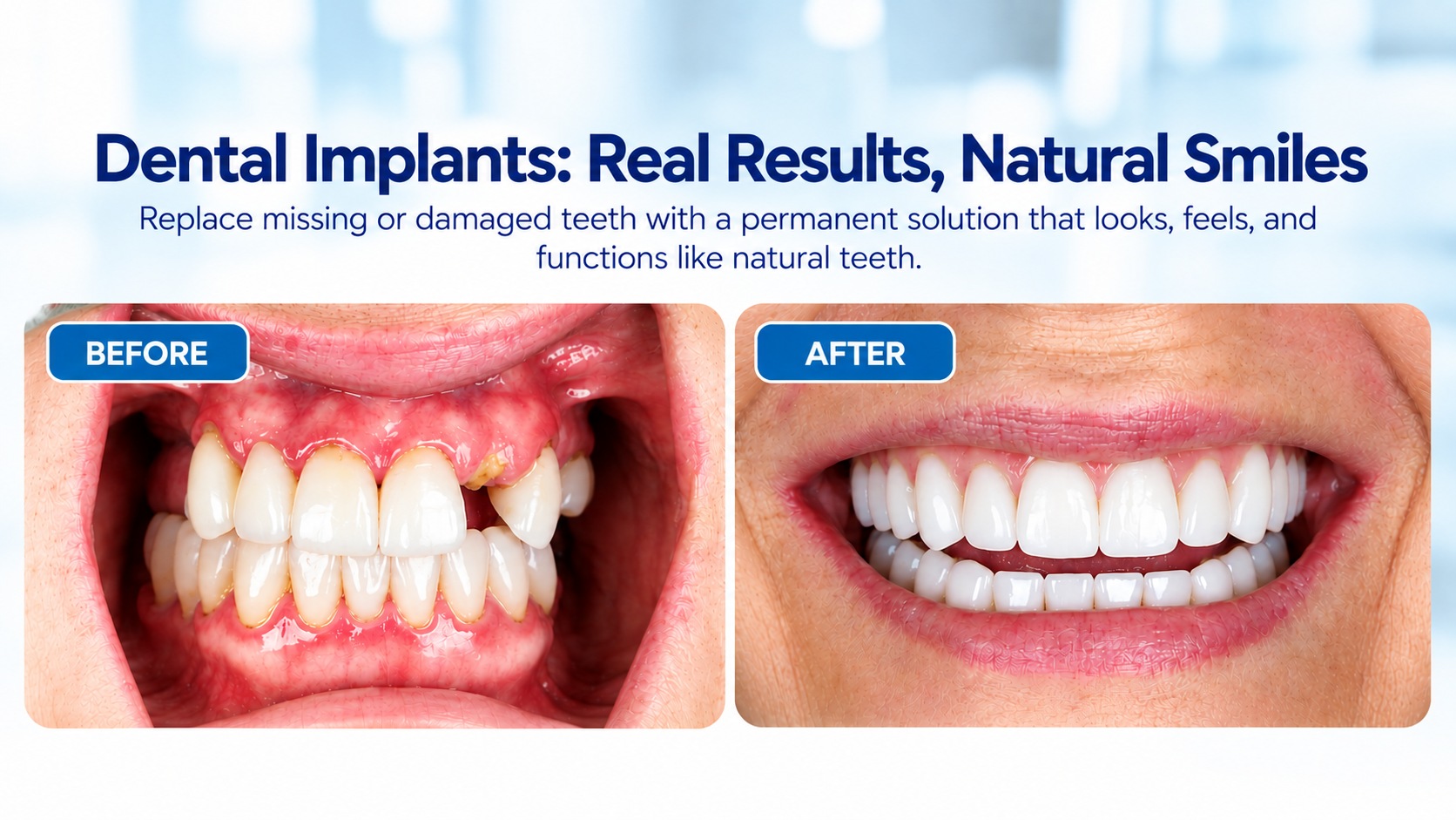 Before-and-after illustration showing missing teeth restored with natural-looking dental implants.